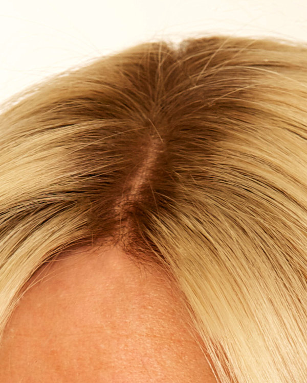 Intralace Gallery before and after Lucinda Ellery's hair loss technique