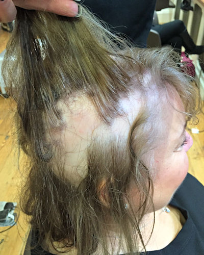 Jenny before applying the Intralace