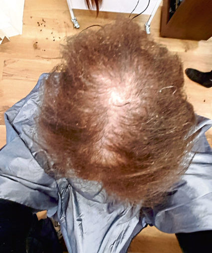 Linda's hair before treatment showing bald areas
